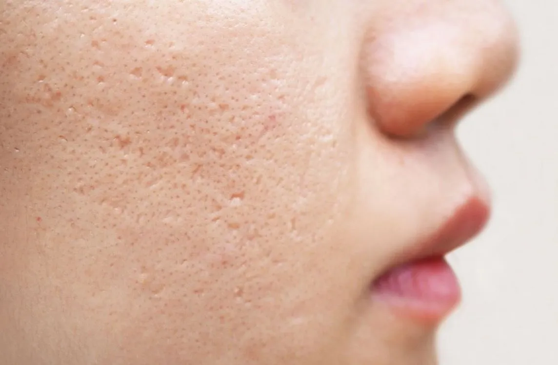 Imagem de Cicatrizes de acne