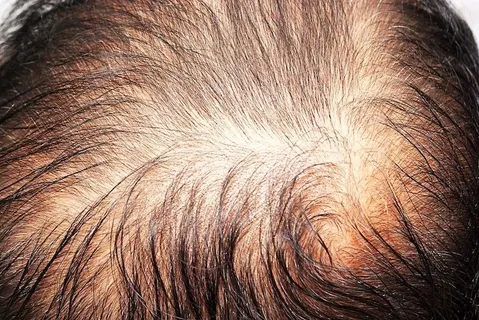 Alopecia androgenetica
