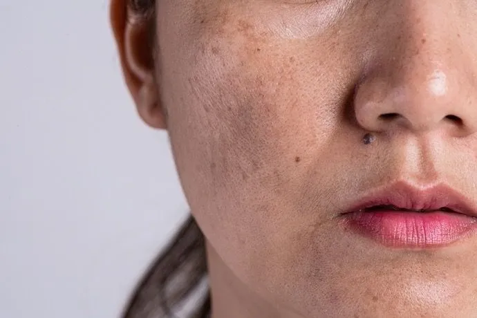 melasma